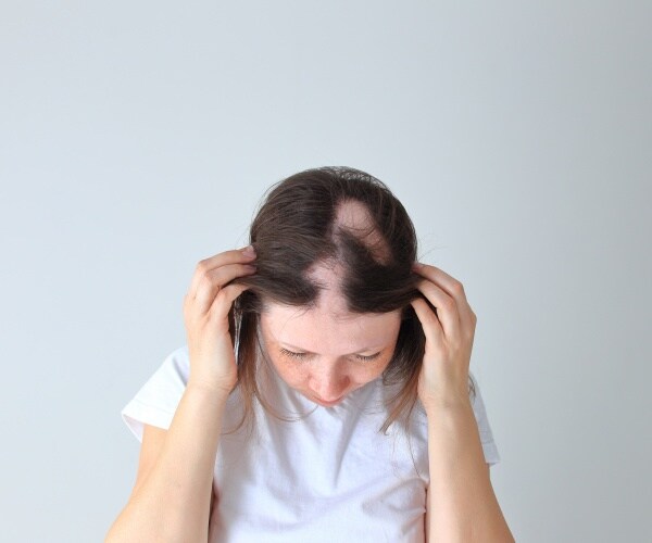 top of woman's head showing hair loss due to alopecia