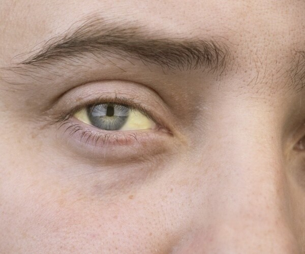 man with yellow in the whites of his eye, indicating jaundice