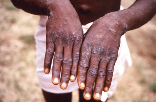 African Officials: Monkeypox Spread Is Already an Emergency