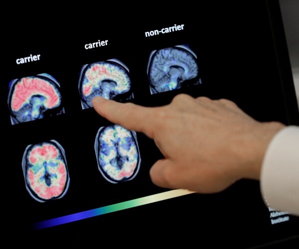 scans of brain with Alzheimer's disease