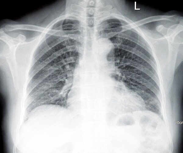 lung/chest CT scan results