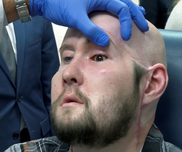 man who received first eye transplant, and a face transplant