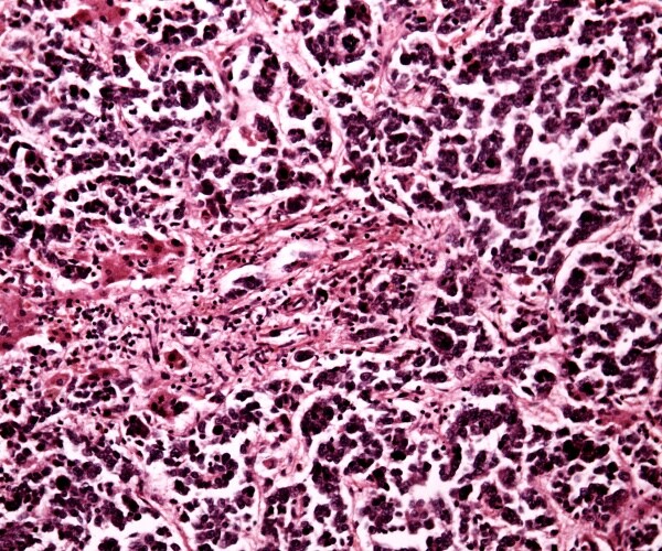 microscopic view of liver cancer