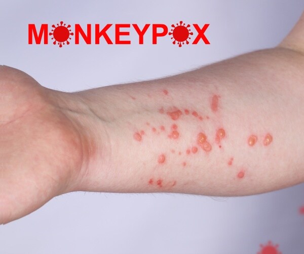 an arm showing monkeypox lesions, "MONKEYPOX" in red