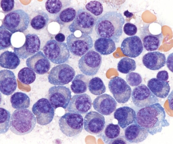 microscopic view of multiple myeloma cells