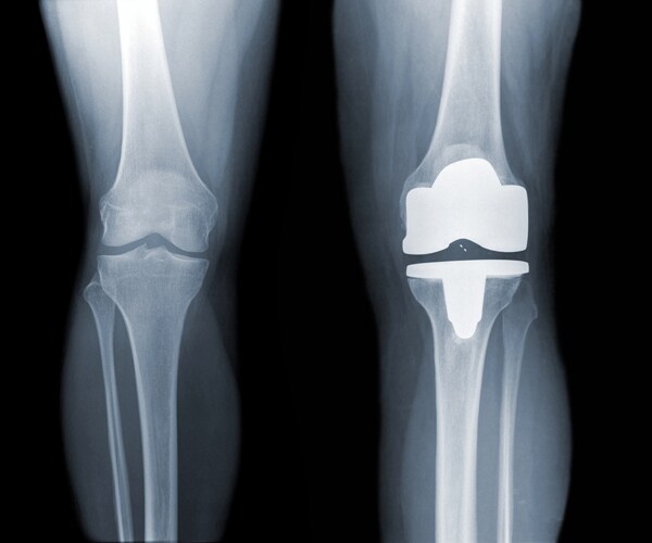 x-ray showing a total knee replacement