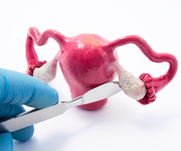 model of female reproductive organs, knife on ovary