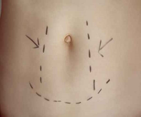 Complications From Tummy Tucks Surpass Other Cosmetic Surgeries