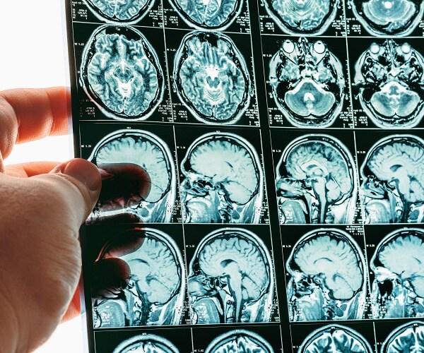 man holding mri brain scan