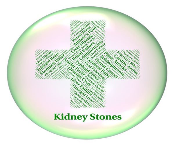 Incidence of Kidney Stones Increasing: Mayo Clinic