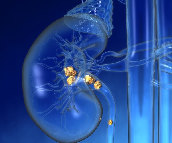 illustration of a kidney with kidney stones