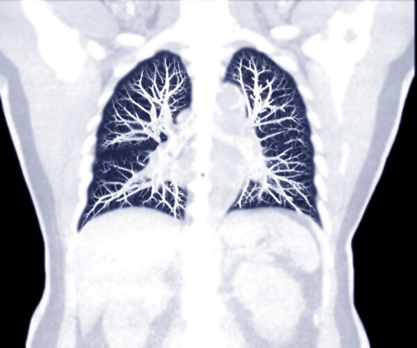 lung x-ray of a pulmonary embolism