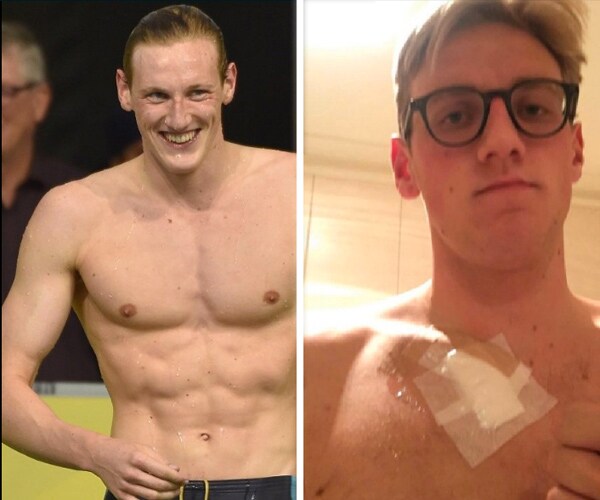 Swimmer's Mole Removed After Being Spotted by Fan