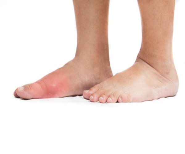 Weight Loss Surgery May Reduce Gout Risk