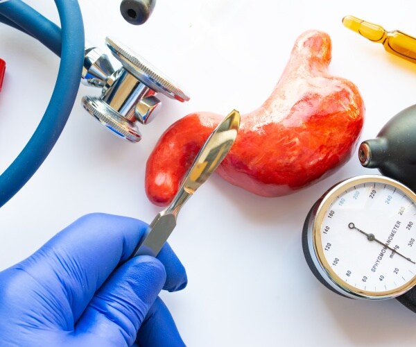 model of a stomach and a gloved hand with knife to portray weight loss surgery