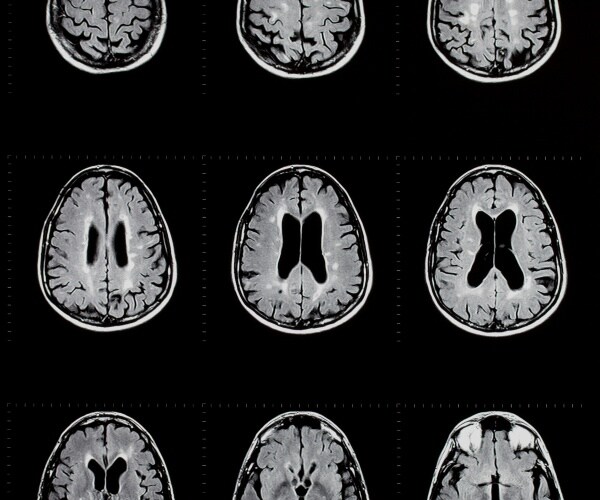 mri of brain showing evidence of multiple sclerosis