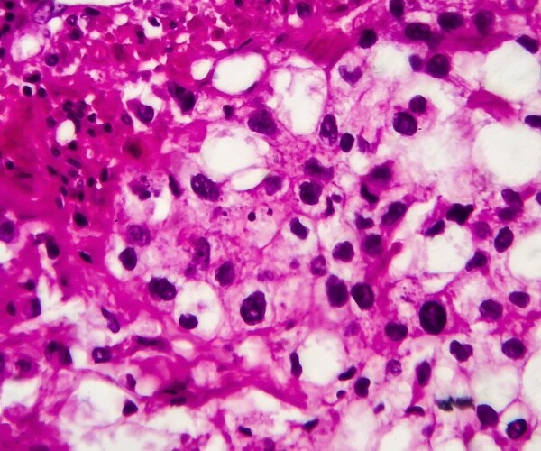 microscopic view of blader cancer