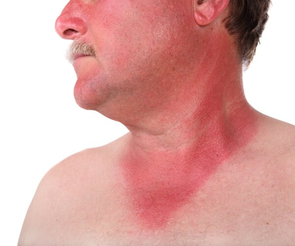 man with sunburn