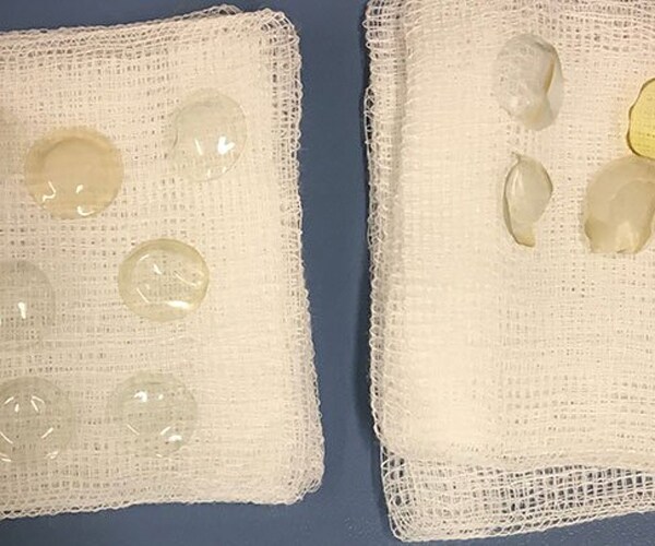 27 Contact Lenses Removed From Woman's Eye