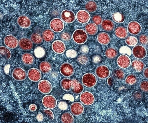 Sweden Reports 1st Case of More Infectious Form of Mpox First Identified in Congo