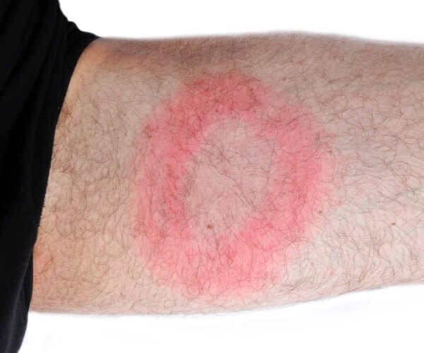 a man's arm with bull's-eye rash from tick bite