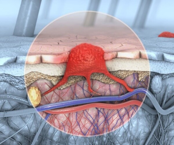 illustration of genital herpes breakout on skin