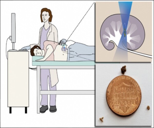 Using ultrasound energy to move kidney stones and (lower right) the fragments' size.