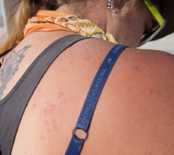 Burning Man Bugs Sucking the Blood Out of This Year's Party