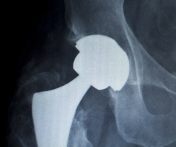 a titanium hip seen through an x-ray