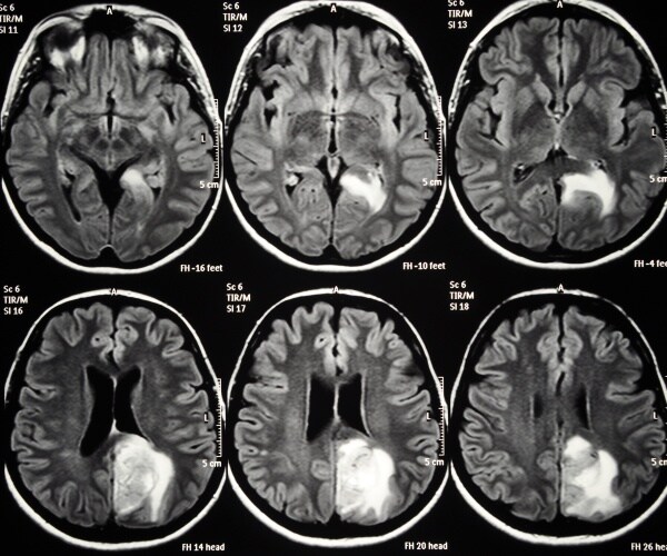 MRI images of brain cancer