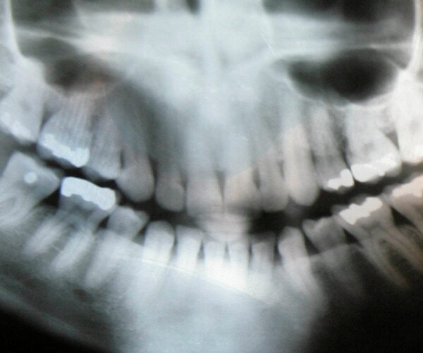 dental x-ray