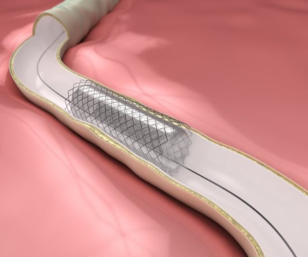 Artery-Opening Stents May Not Help Angina