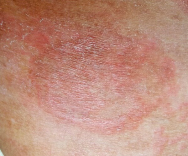 red, scaly patches on skin