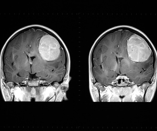 mri of brain showing tumor