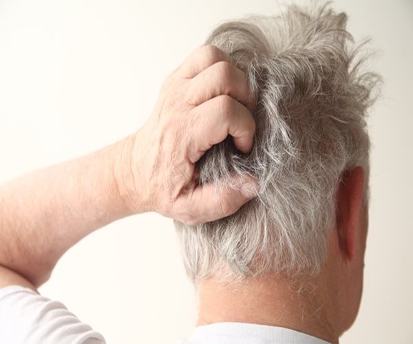 Dandruff Caused by Competing Bacteria