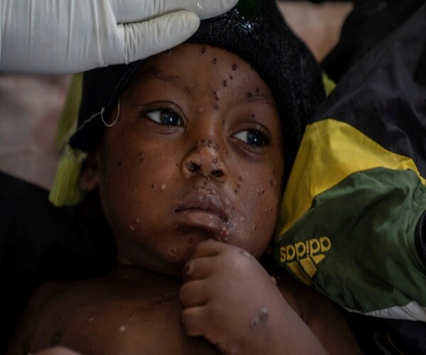 boy in Congo with mpox