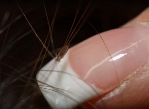 Resistant Lice Crawling Over Kids' Heads in 25 States Now