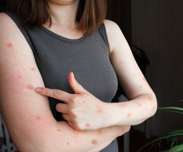 woman in short sleeves pointing to monkeypox rash on arms