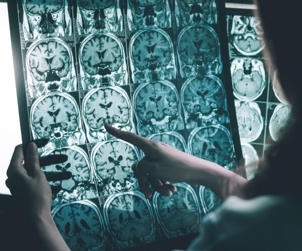 evidence of alzheimer's on brain MRI