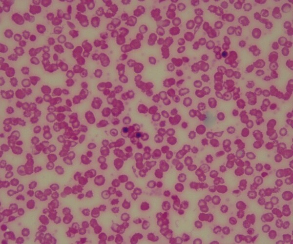 red blood cells under microscope of a patient with sickle cell disease