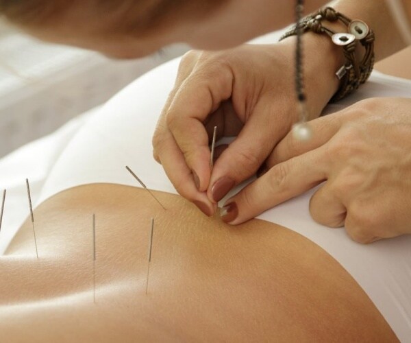 woman receiving acupuncture treatment with needles on her back