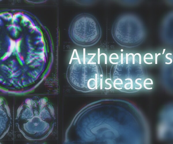 'Alzheimer's Disease' with brain images