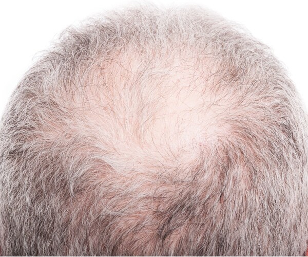 New Drug Reverses Hair Loss in Mice