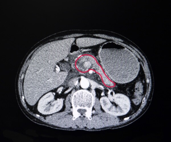 mri of pancreas, showing cancer