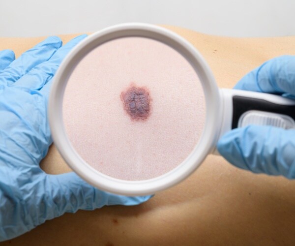 close up of doctor examining mole on a patient's shoulder under a magnifying glass