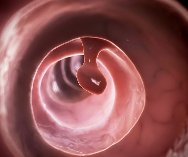 3d rendering of a colon polyp