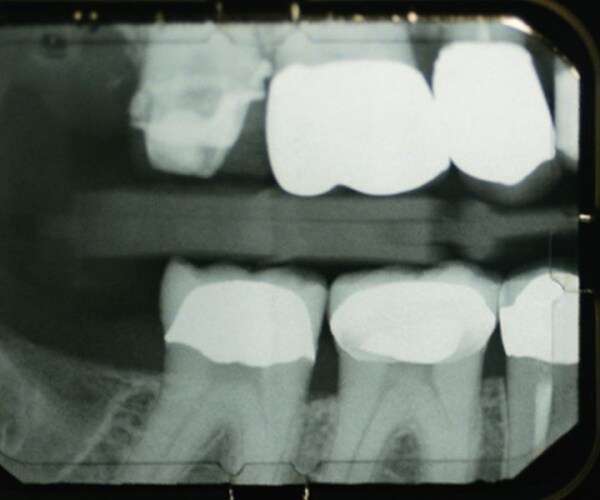 X-rays of teeth of someone who grinds their teeth