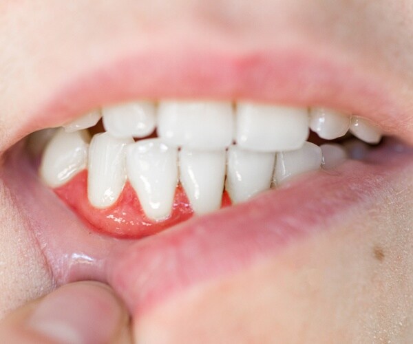 close-up of a finger pulling down lip to show bloody gums/gum disease