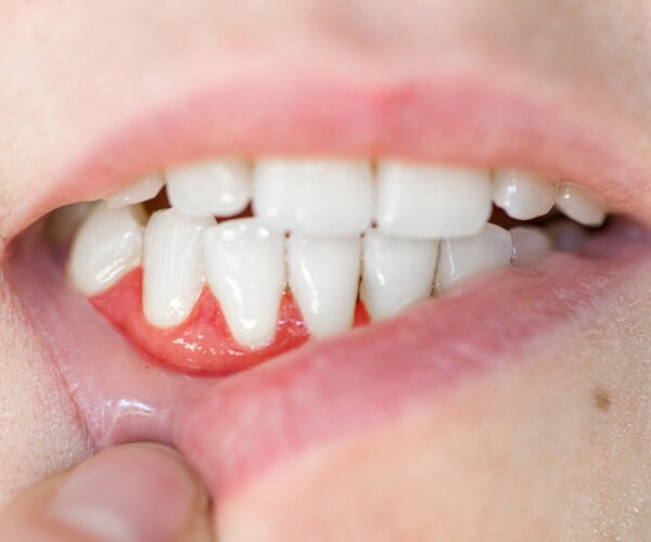 closeup of a mouth showing teeth and red gums with periodontal disease