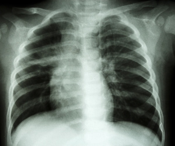 x-ray of a child's chest showing tuberculosis in lungs